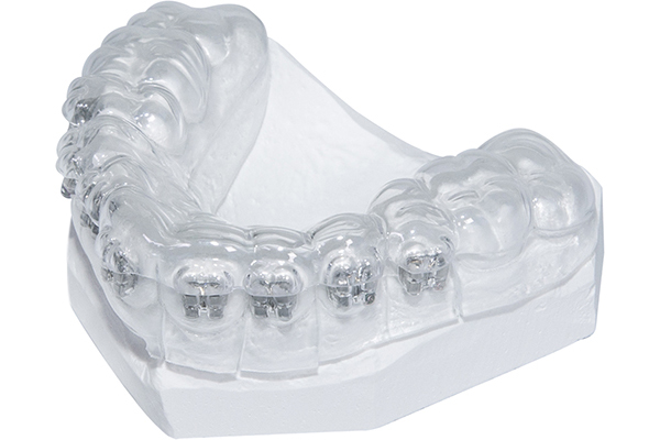 Férulas de transferencia brackets